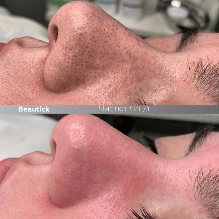 Чистка лица