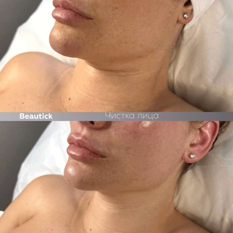 Инъекционная косметология