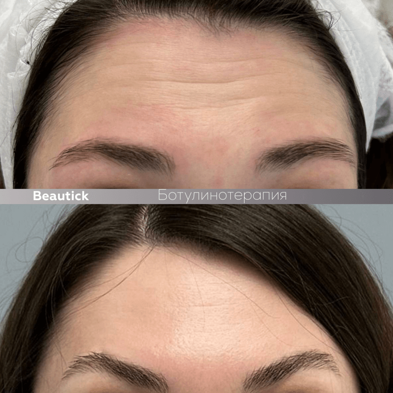 Ботулинотерапия