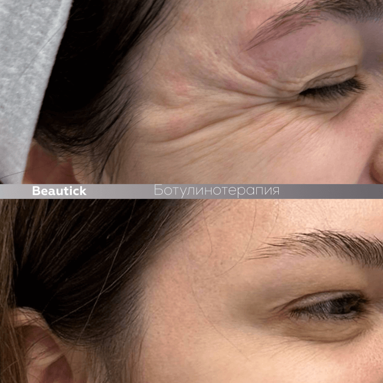 Ботулинотерапия