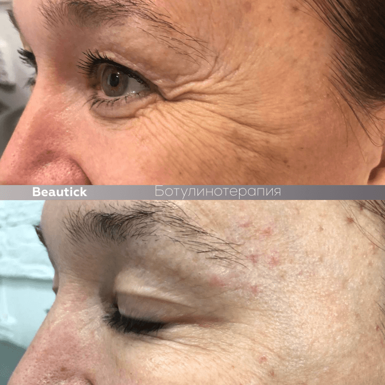 Ботулинотерапия