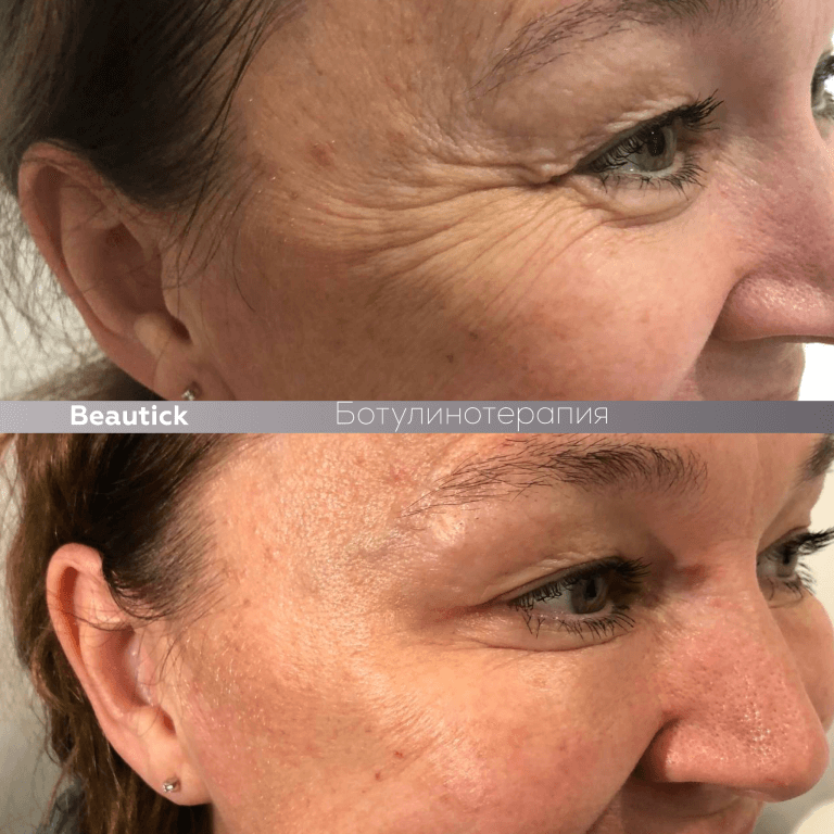 Ботулинотерапия