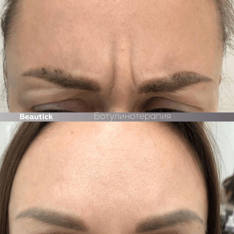 Ботулинотерапия