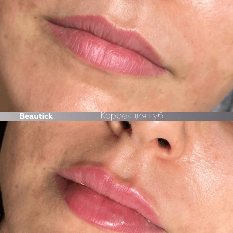 Контурная пластика губ