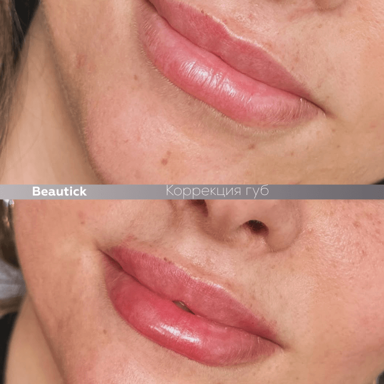 Контурная пластика губ