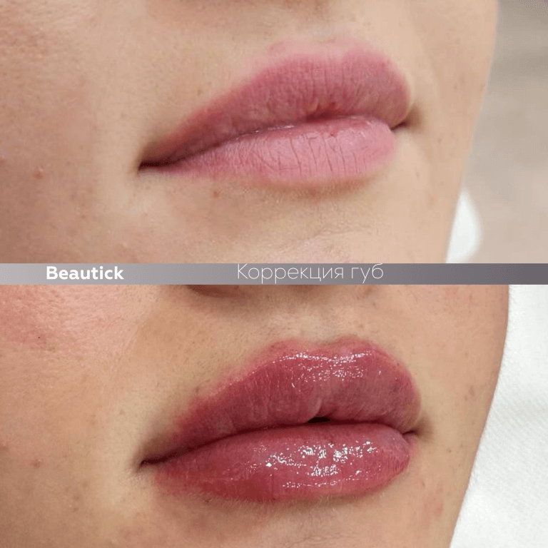 Инъекционная косметология