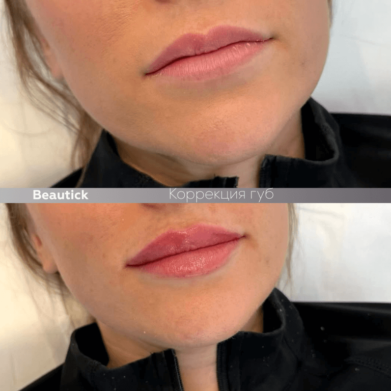 Контурная пластика губ