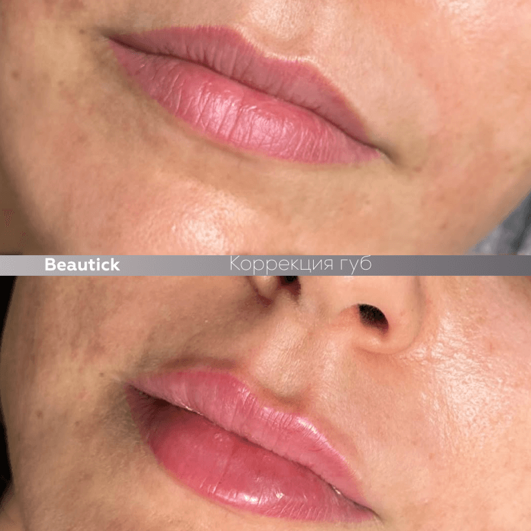 Инъекционная косметология