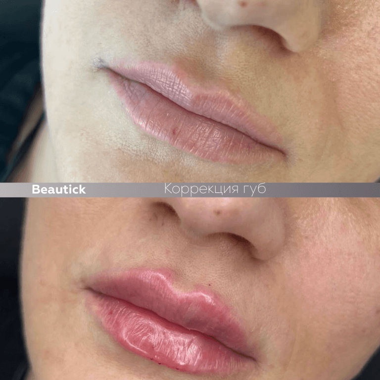 Инъекционная косметология