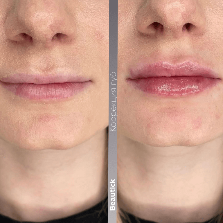Контурная пластика губ