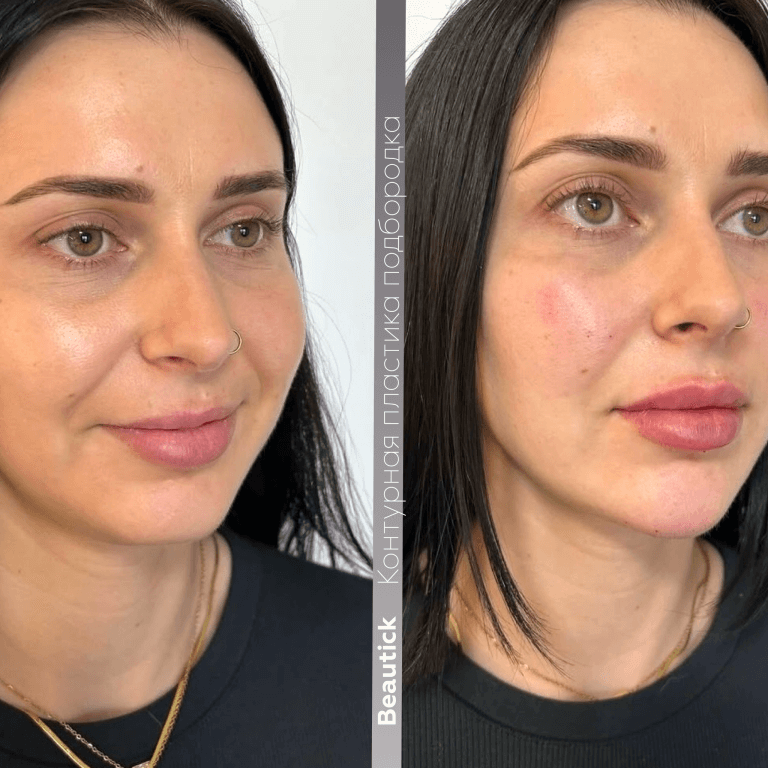 Контурная пластика подбородка