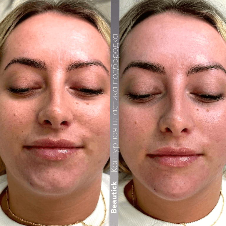 Инъекционная косметология