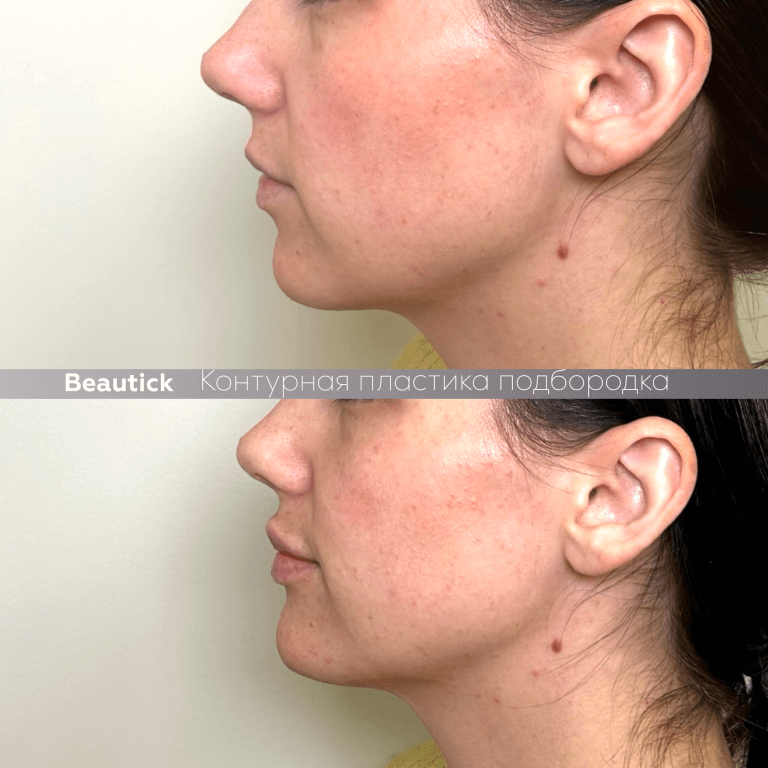 Контурная пластика подбородка