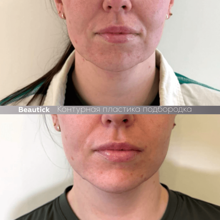 Контурная пластика подбородка