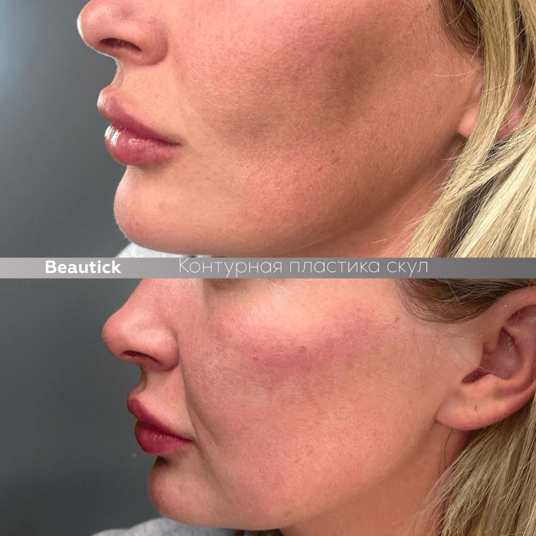 Контурная пластика скул