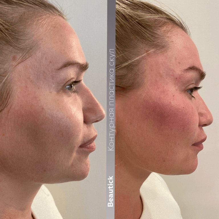 Контурная пластика скул