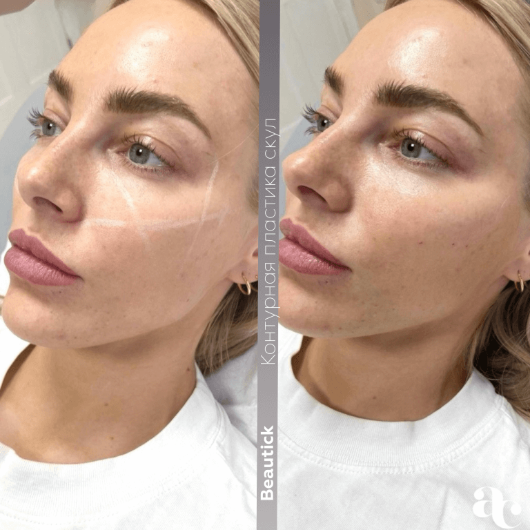 Инъекционная косметология