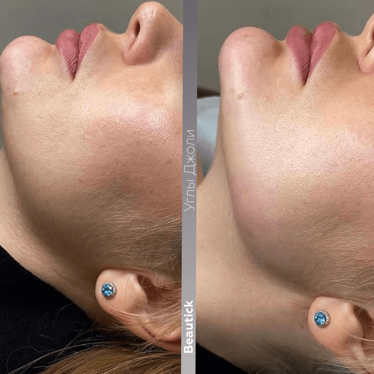 Инъекционная косметология