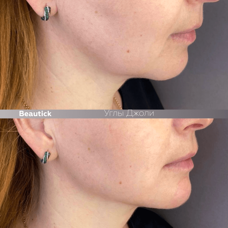 Углы Джоли