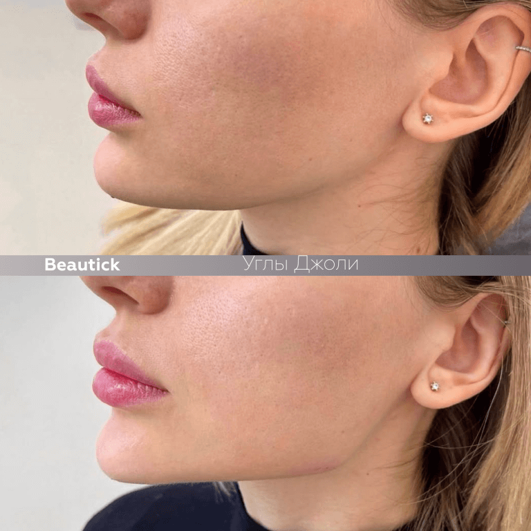 Инъекционная косметология