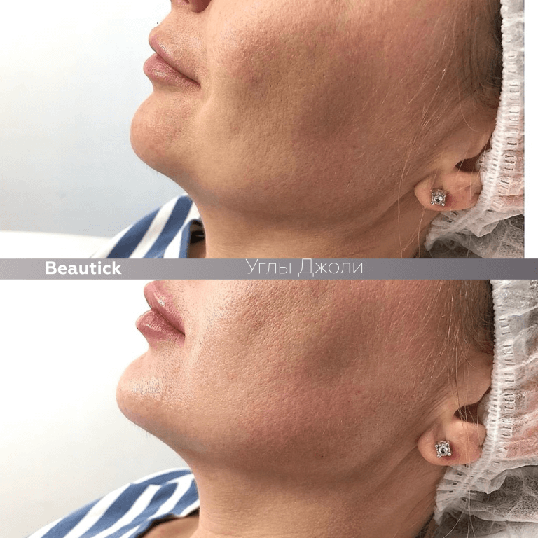 Углы Джоли