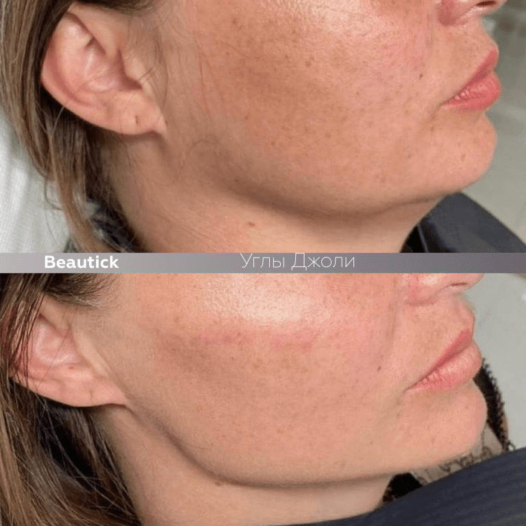 Углы Джоли