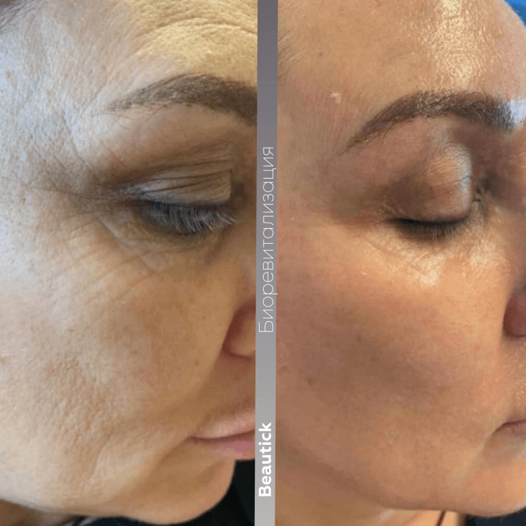 Биоревитализация