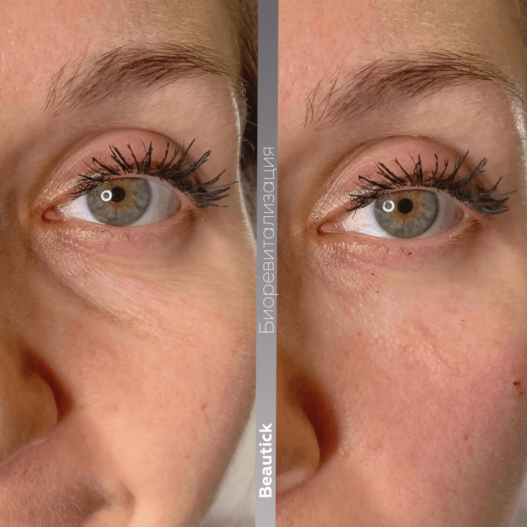 Биоревитализация