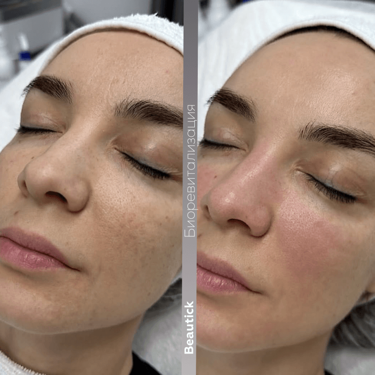 Биоревитализация