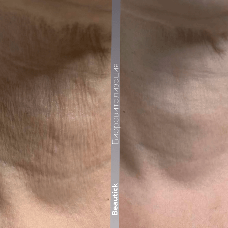 Биоревитализация