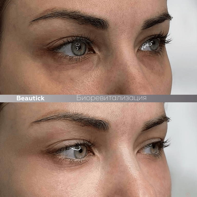 Биоревитализация