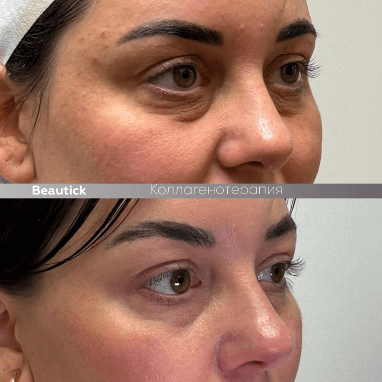 Коллагенотерапия