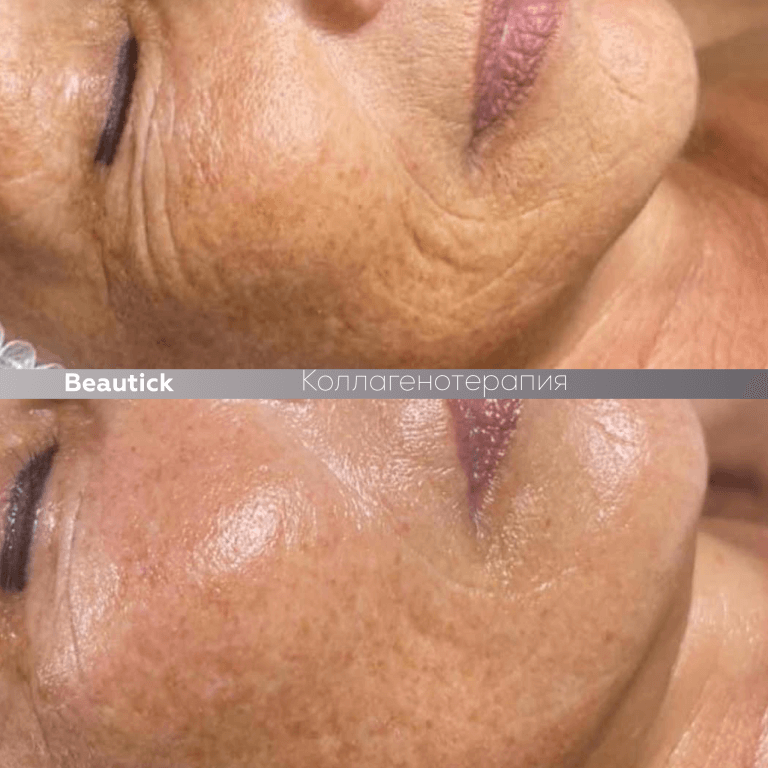 Коллагенотерапия