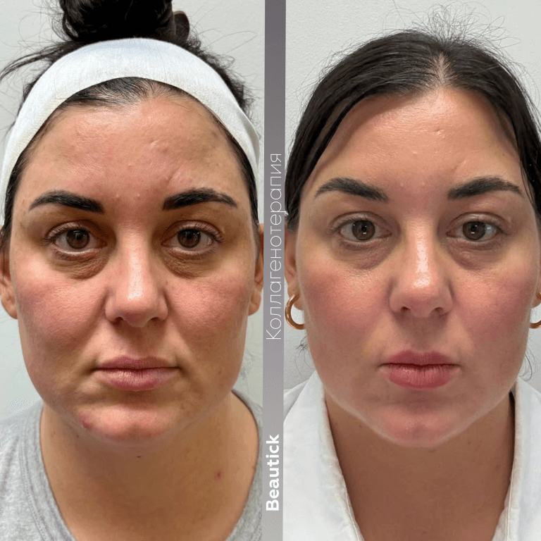 Коллагенотерапия