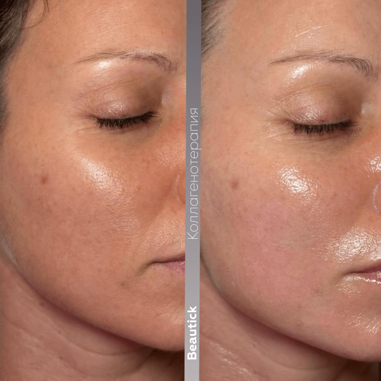 Коллагенотерапия