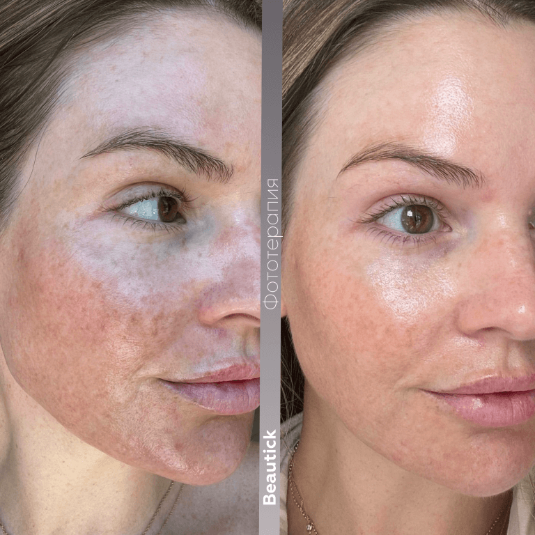 Фотоомоложение / Фотолечение IPL