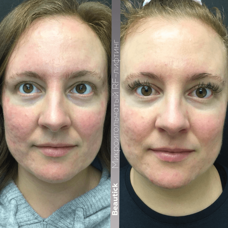 Микроигольчатый RF-лифтинг