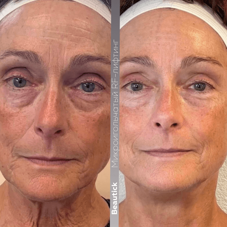 Микроигольчатый RF-лифтинг