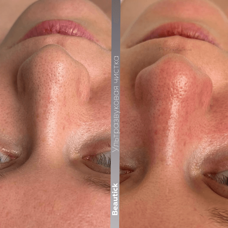 Ультразвуковая чистка лица