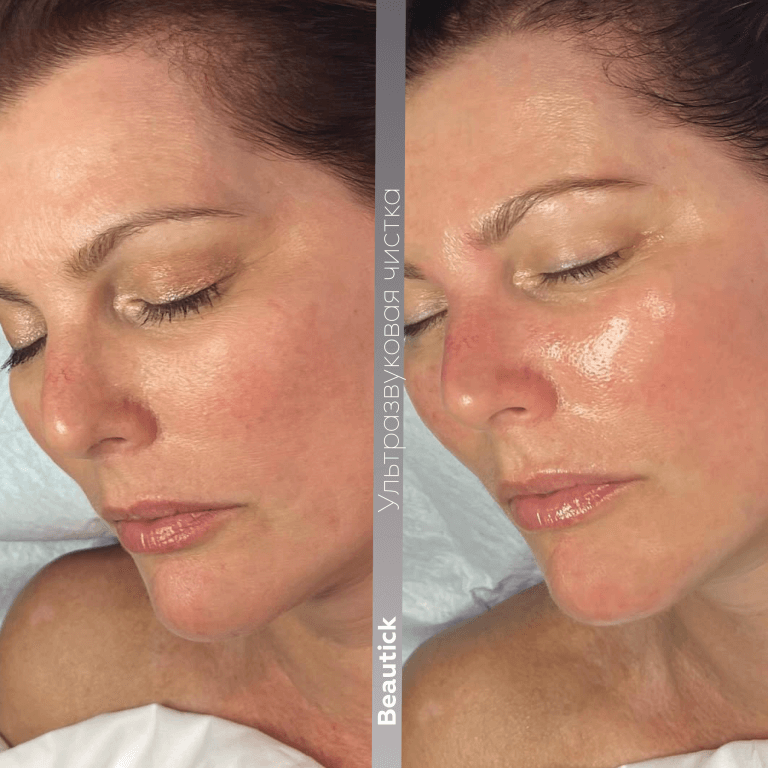 Ультразвуковая чистка лица