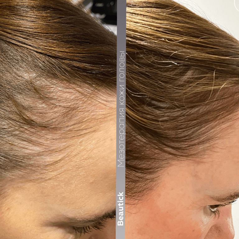 Мезотерапия для кожи головы