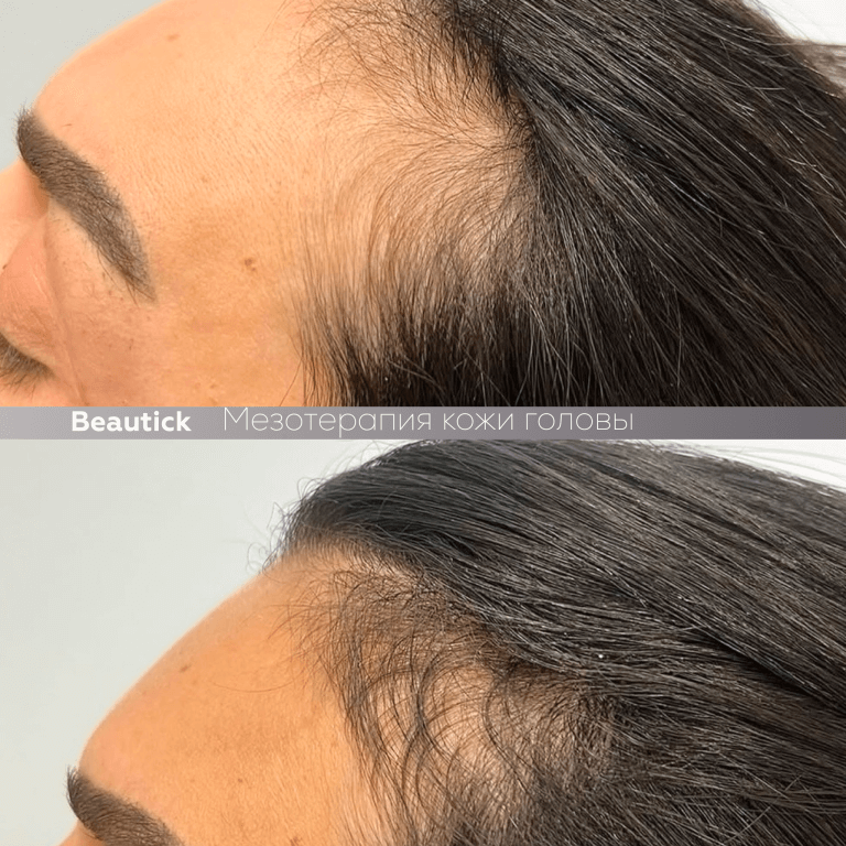 Мезотерапия для кожи головы