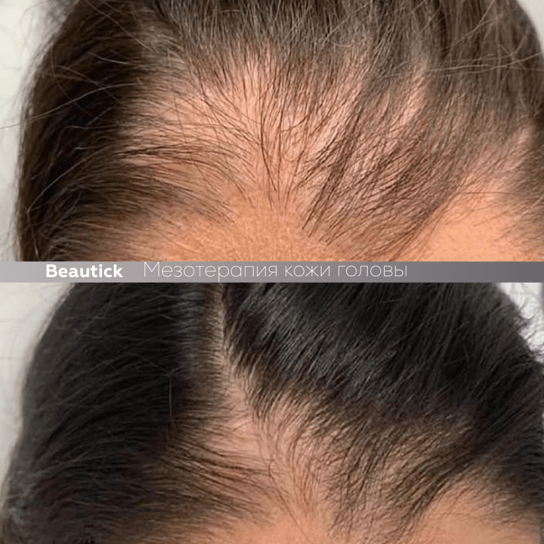 Мезотерапия для кожи головы