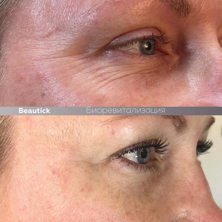 Мезотерапия