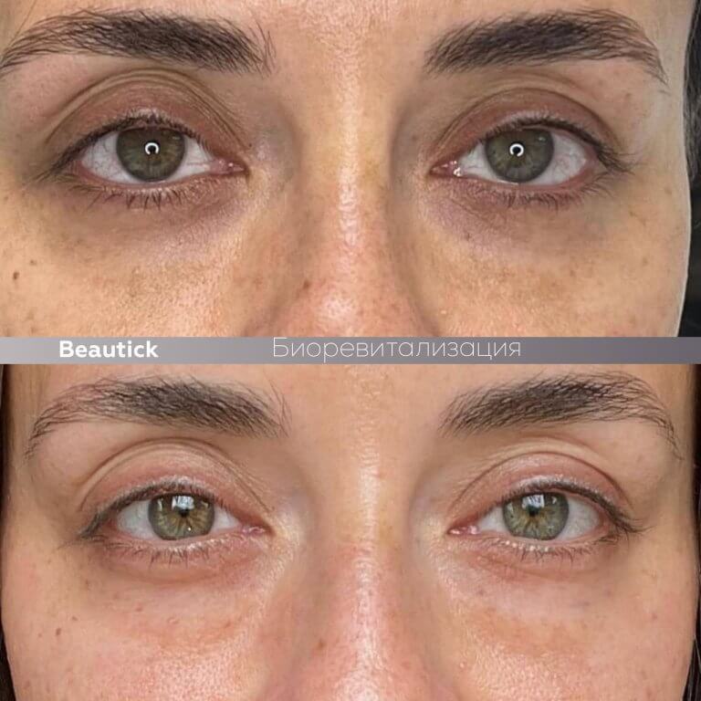 Мезотерапия