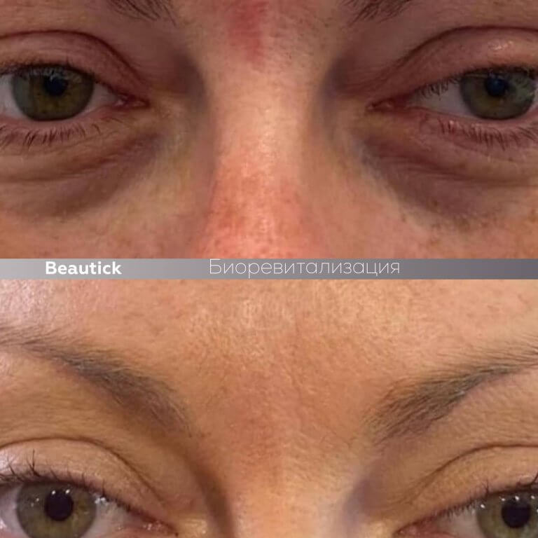 Мезотерапия