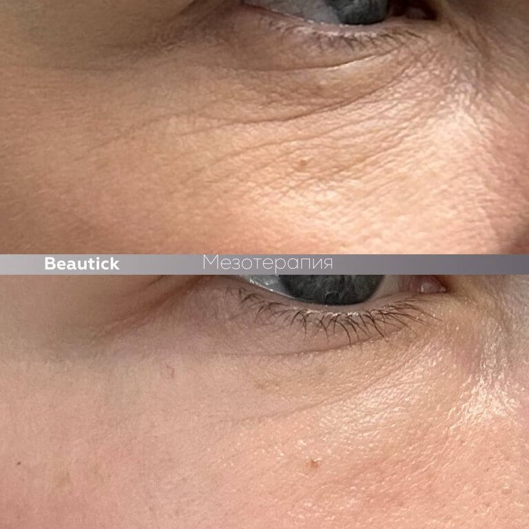 Мезотерапия