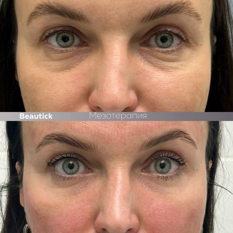 Мезотерапия