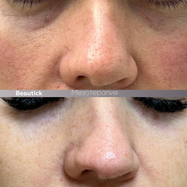 Мезотерапия