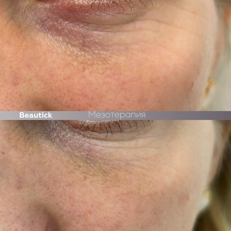 Мезотерапия